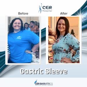 Gastric Sleeve