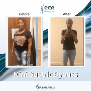 Mini Gastric Bypass