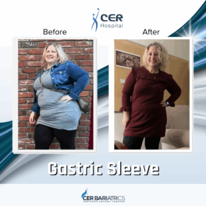 Gastric Sleeve