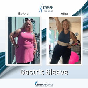 Gastric Sleeve