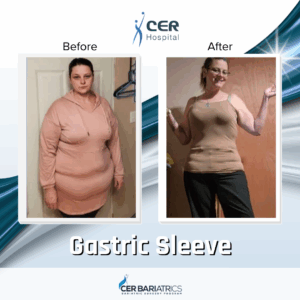 Gastric Sleeve