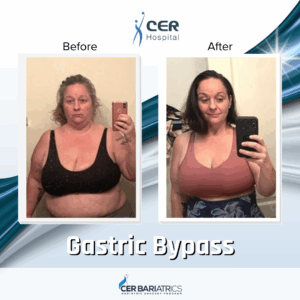 Gastric Bypass