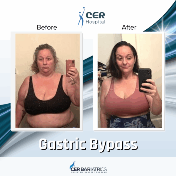 Gastric Bypass