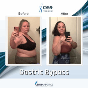 Gastric Bypass