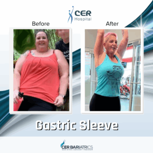 Gastric Sleeve