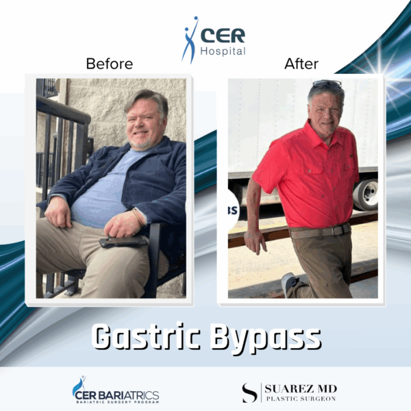 Gastric Bypass