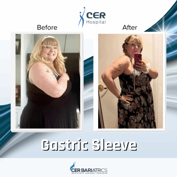 Gastric Sleeve - Image 2