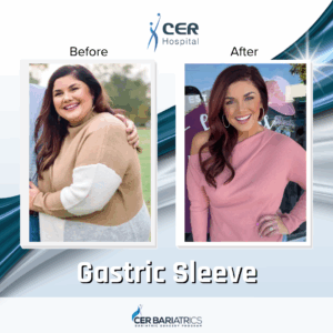 Gastric Sleeve