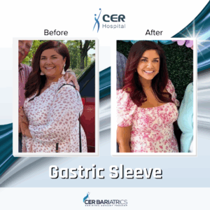 Gastric Sleeve