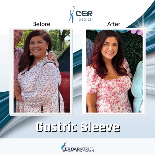 Gastric Sleeve - Image 2