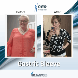 Gastric Sleeve