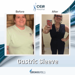 Gastric Sleeve