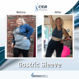 Gastric Sleeve