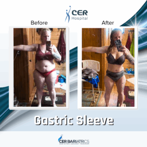 Gastric Sleeve