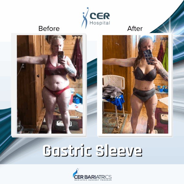 Gastric Sleeve