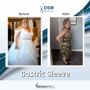 Gastric Sleeve