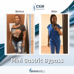Mini Gastric Bypass