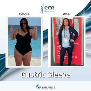 Gastric Sleeve