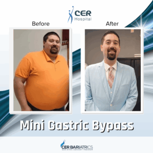 Mini Gastric Bypass