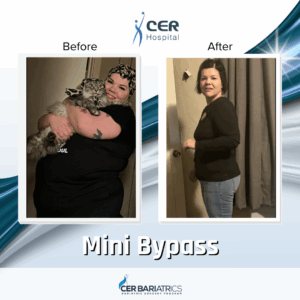 Mini Bypass