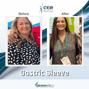 Gastric Sleeve
