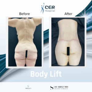 Mommy Makeover – 310125