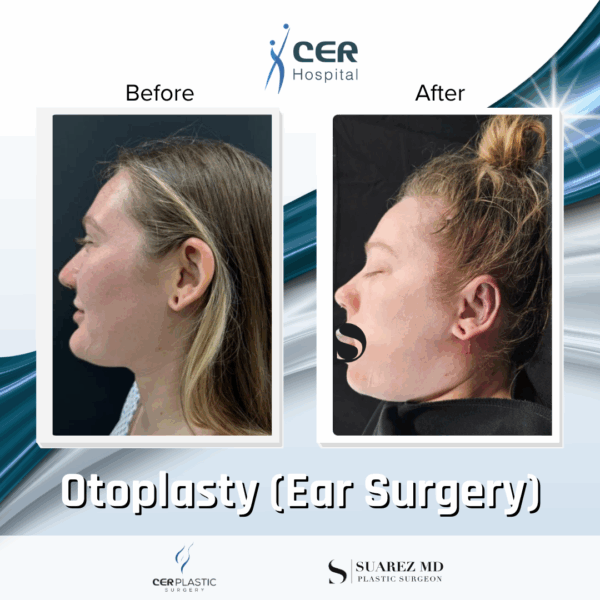 Otoplasty - 4094 - Image 4