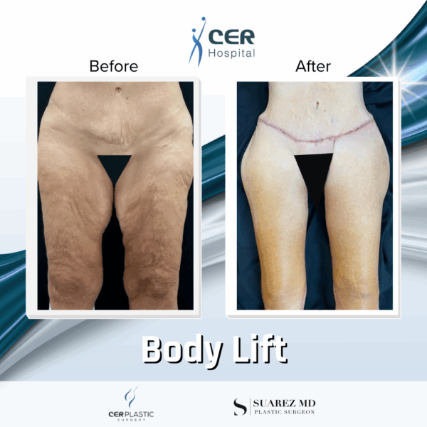 Body Lift - 18094 - Image 4