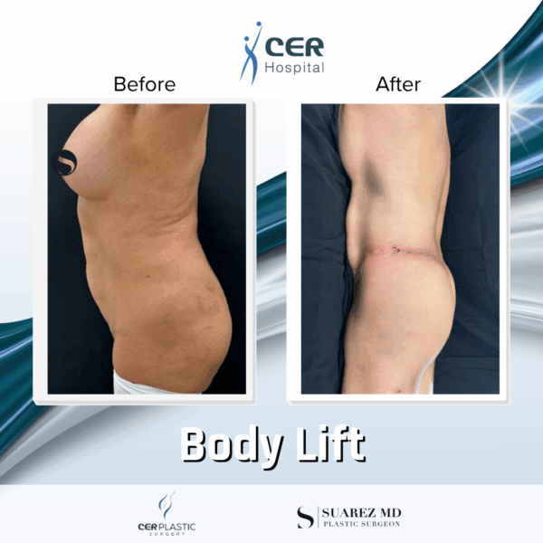 Body Lift - 2104 - Image 4