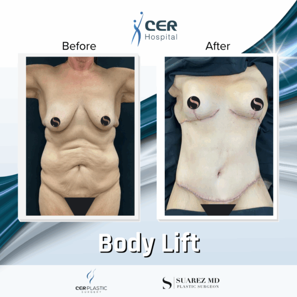 Body Lift - 9104 - Image 8