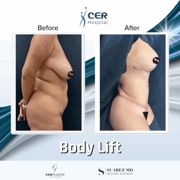 Body Lift - 20084 - Image 4