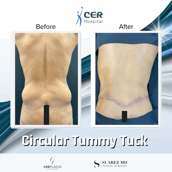 Circular Tummy Tuck - 11104 - Image 4
