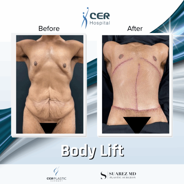 Body Lift - 3074 - Image 4
