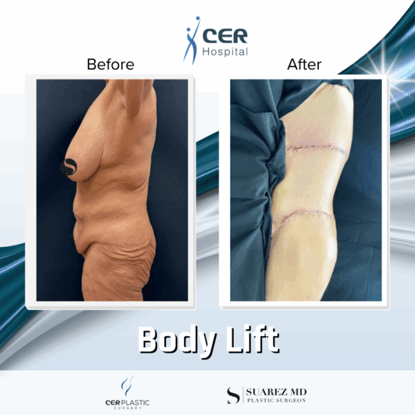 Body Lift - 0608