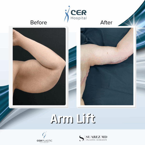 Arm Lift - 24074 - Image 4