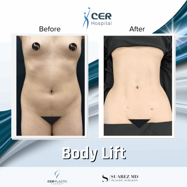 Body Lift - 22054