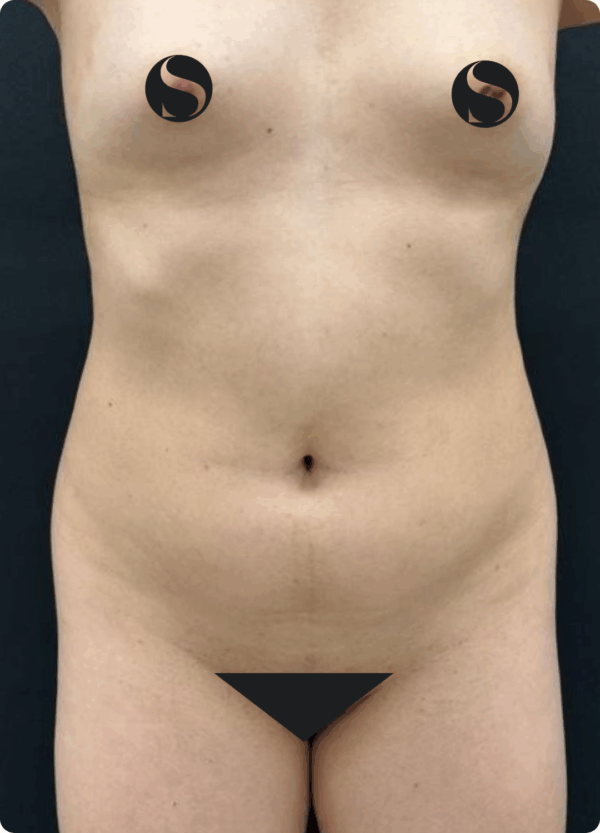 Body Lift - 22054 - Image 3