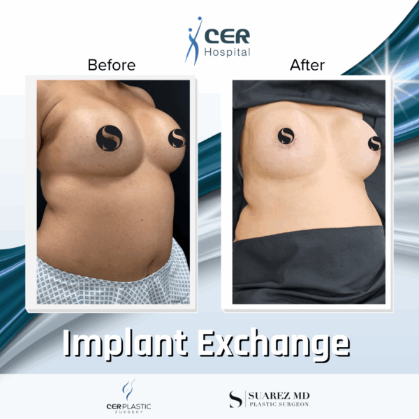 Implant Exchange - 24054 - Image 4