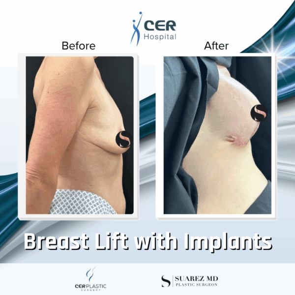 Breast Lift with Implants - 24054 - Image 4