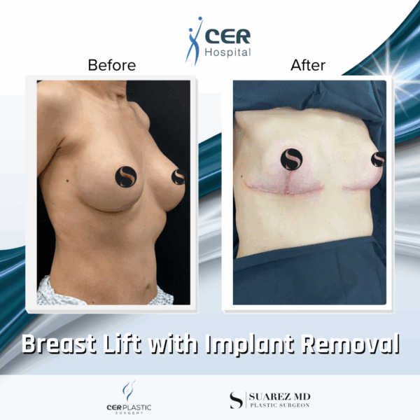 Breast Lift with Implant Removal - 14104 - Image 4