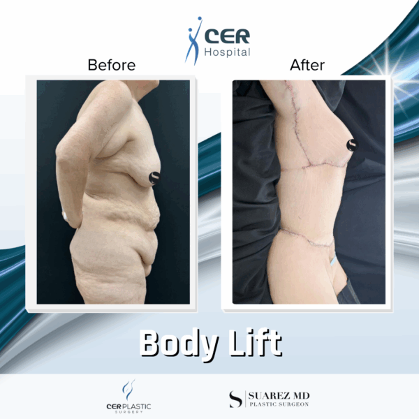 Body Lift - 24104 - Image 4