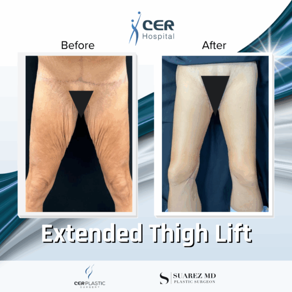 Extended Thigh Lift - 30104 - Image 4