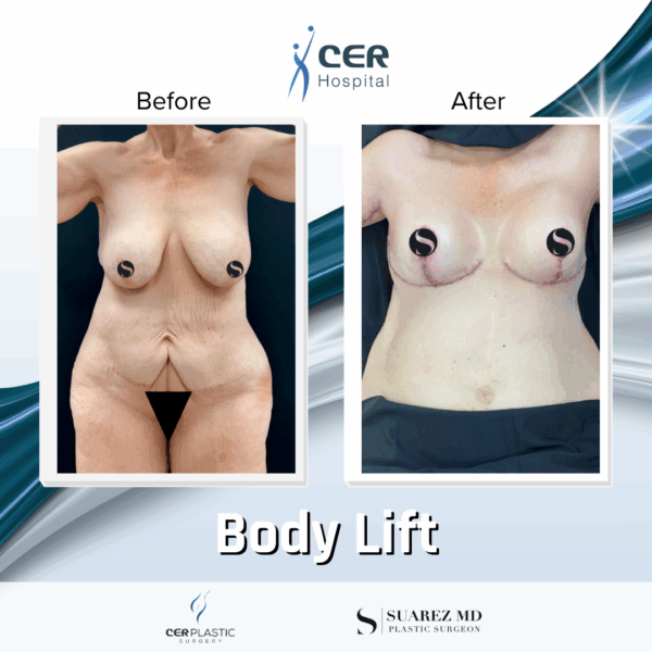 Body Lift - 10124 - Image 4
