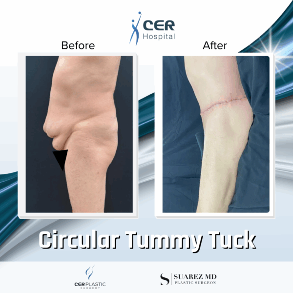 Circular Tummy Tuck - 11124