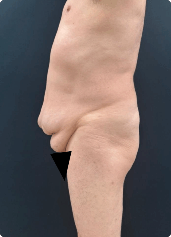 Circular Tummy Tuck - 11124 - Image 3