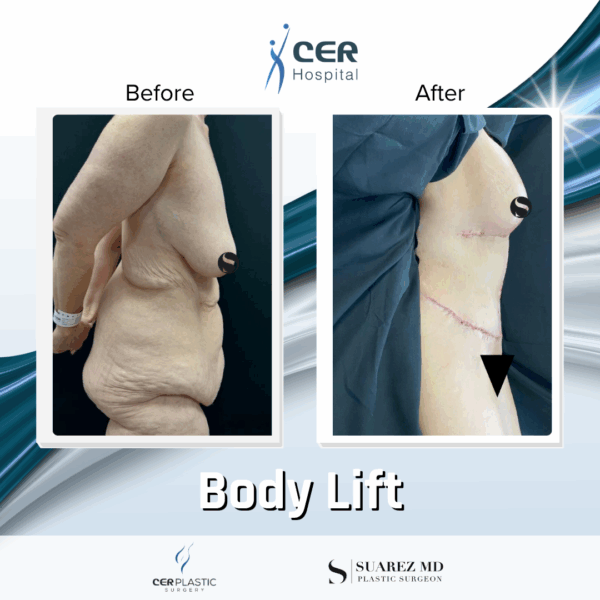 Body Lift - 18124 - Image 4