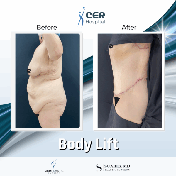 Body Lift - 7013 - Image 4
