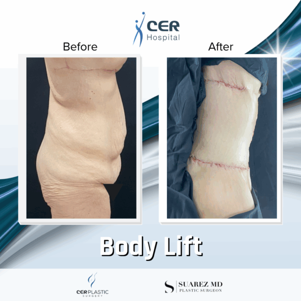 Body Lift - 8013 - Image 4