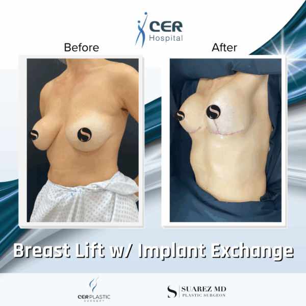 Breast Lift with Implant Exchange - 9013 - Image 4