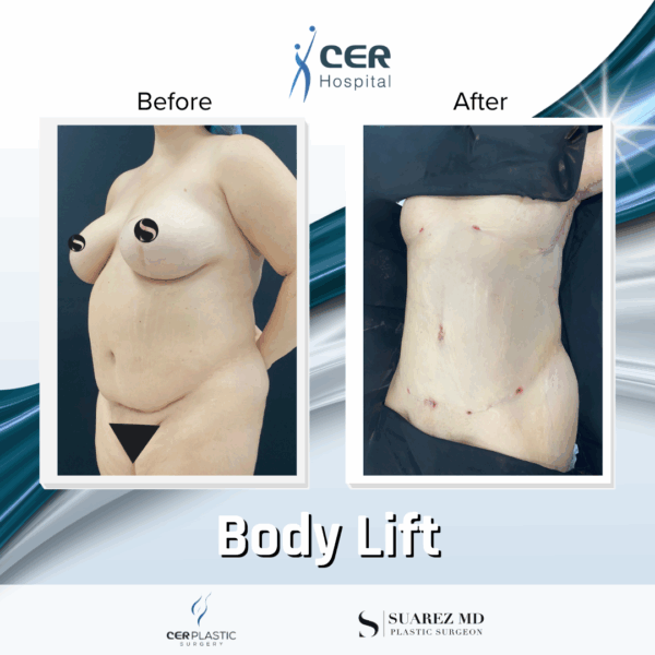 Body Lift - 11013 - Image 4